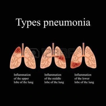 TYPES OF LUNGS INFECTION